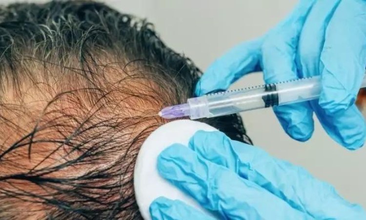 Corticosteroid tiêm được sử dụng trong điều trị rụng tóc Corticosteroid tiêm được sử dụng trong điều trị rụng tóc