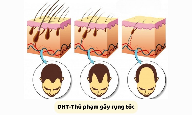 DHT khiến nang tóc bị thu nhỏ và tóc gãy rụng DHT khiến nang tóc bị thu nhỏ và tóc gãy rụng