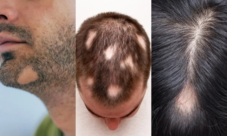 Hiện tượng rụng tóc có hình đồng xu Hiện tượng rụng tóc có hình đồng xu