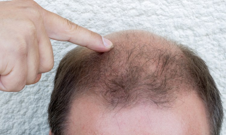 Kiểu rụng tóc Androgenetic Alopecia mà nhiều nam giới đang gặp phải Kiểu rụng tóc Androgenetic Alopecia mà nhiều nam giới đang gặp phải