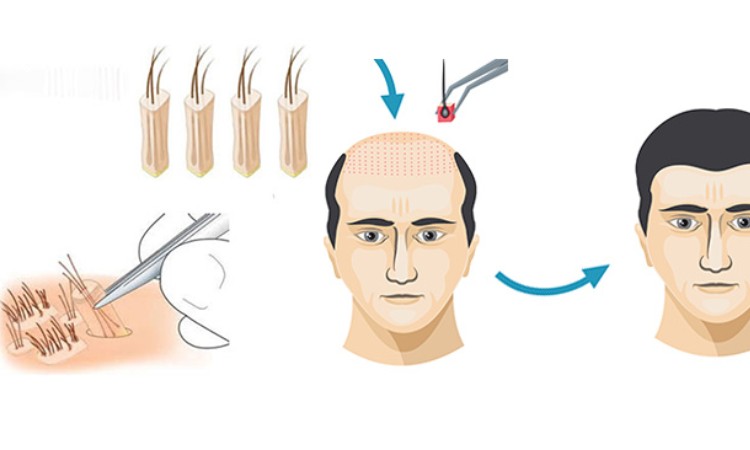 Phương pháp cấy tóc tự thân hiện nay được khá nhiều người lựa chọn Phương pháp cấy tóc tự thân hiện nay được khá nhiều người lựa chọn