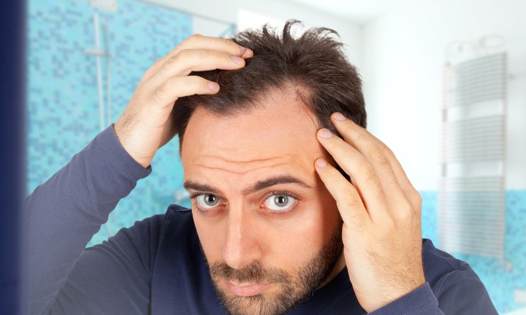 Rụng tóc hình chữ M là một trong những hiện tượng phổ biến Rụng tóc hình chữ M là một trong những hiện tượng phổ biến