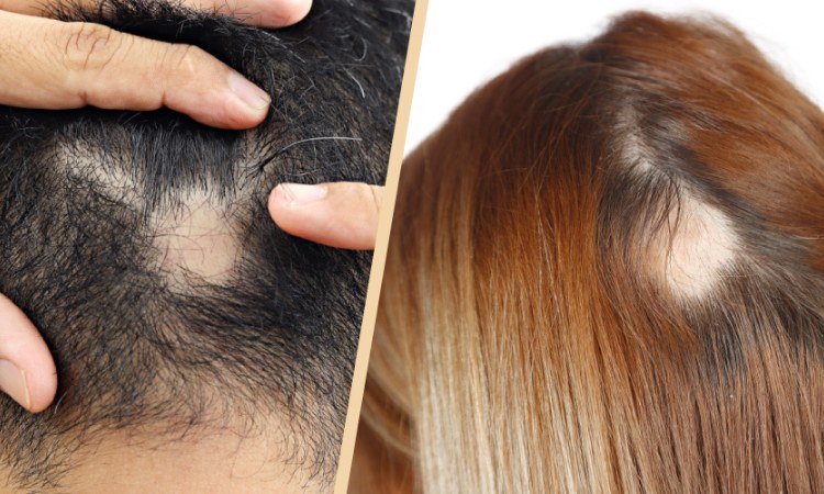 Rụng tóc từng mảng kiểu đồng xu có thể mọc lại Rụng tóc từng mảng kiểu đồng xu có thể mọc lại