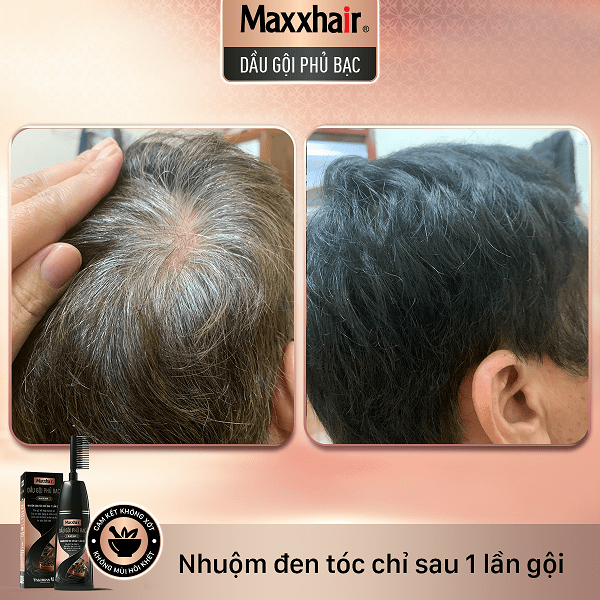 Khách hàng đã gội nhuộm đen tóc từ Dầu gội phủ bạc Maxxhair 1 Khách hàng đã gội nhuộm đen tóc từ Dầu gội phủ bạc Maxxhair 1